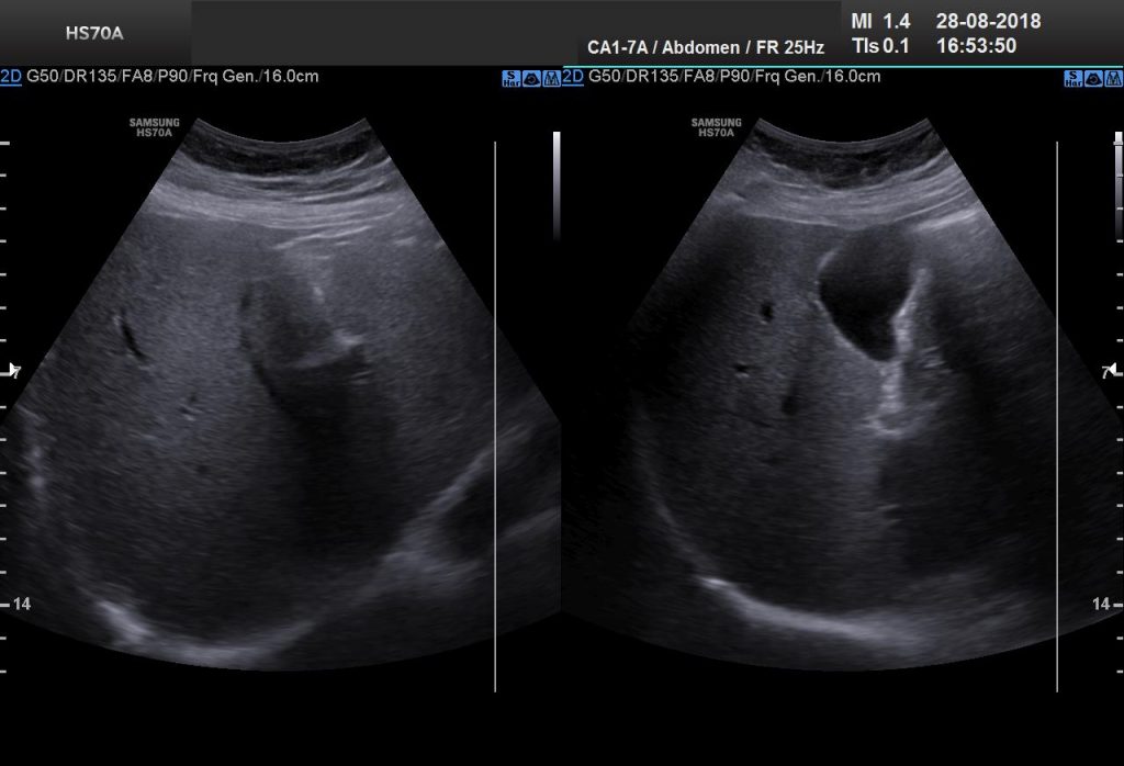 Ultrasonografie cu prostatită
